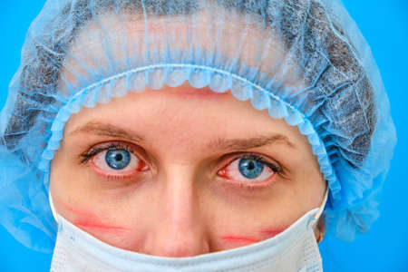 Doctor with facial wounds in a medical mask, close-up. A nurse on a blue background with red marks from a protective mask.の写真素材