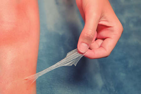 Skin problems in women using bad cream from sunburnの写真素材