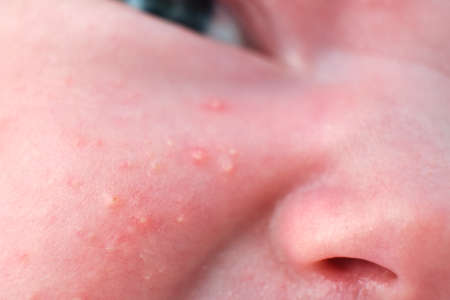 Acne on the face of a newborn child, close-up. Macro photos of skin defects in the babyの写真素材