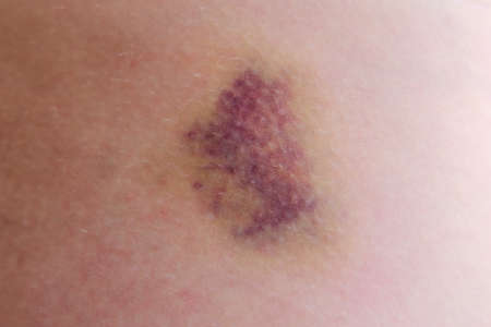 Large bruise on the human body, close upの写真素材