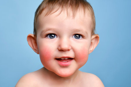 Happy toddler baby with allergies on her face, blue studio background. Portrait of a smiling allergic child with red cheeks. Kid age one yearの写真素材