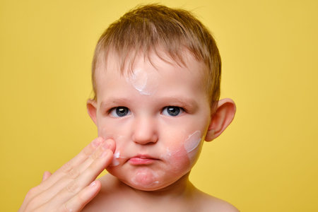 Mother smears allergy cream on face of toddler baby, studio yellow background. Close-up portrait of a cute baby with cream on her cheeks. Kid aged one year and two monthsの写真素材