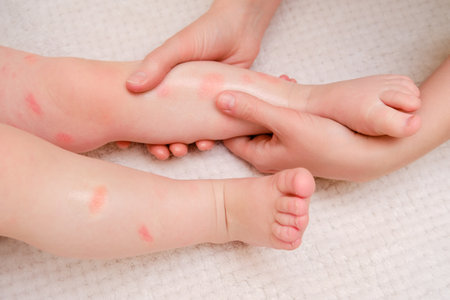 Toddler baby skin care, allergies and dermatitis. A mother woman smears red spots of allergy and atopic dermatitis on the child skin with cream. Kid aged one year eight monthsの写真素材