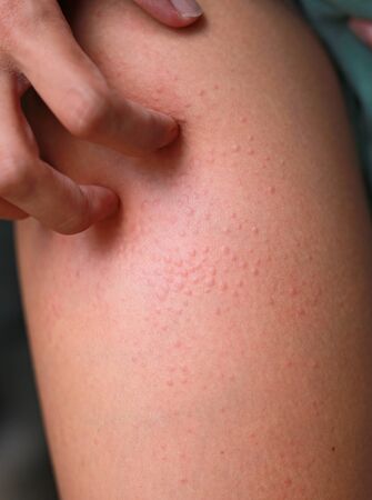 Allergic rash dermatitis eczema on skin. Hand scratching.