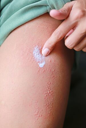 Hand applying ointment to dermatitis skin allergic rash. Skin care concept.
