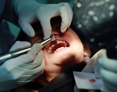 Little girl during dental extraction. Child with a teeth broken and rotten.の写真素材