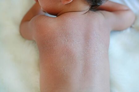 Close up baby back dry skin. Baby have very dry peeling skin.の写真素材