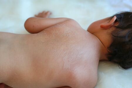Close up baby back dry skin. Baby have very dry peeling skin.の写真素材