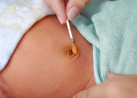 Treatment of newborn baby navel with a cotton swab.の写真素材