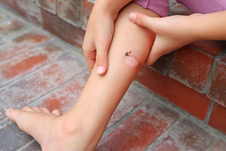 Child Leg wounds caused by hot blanching from motorcycle exhaust pipes.
