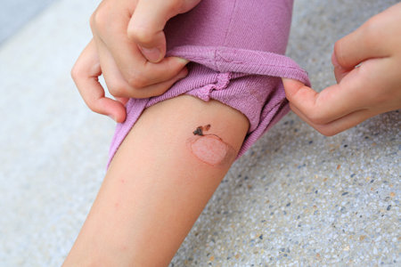 Child Leg wounds caused by hot blanching from motorcycle exhaust pipes.