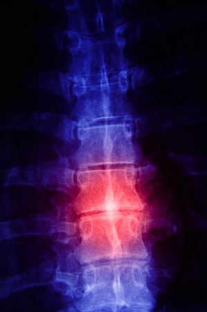 X-ray of a human spine with red for painの写真素材
