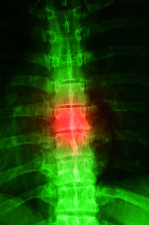 X-ray of a human spine with red for painの写真素材