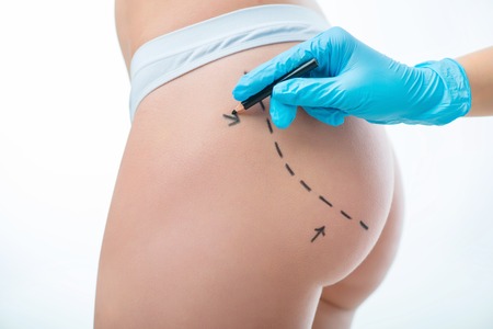 Involved in preparation. Close up of hand of professional plastic surgeon drawing lines on body of...