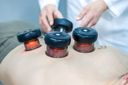 Experienced therapist putting medical cups on patients backの写真素材