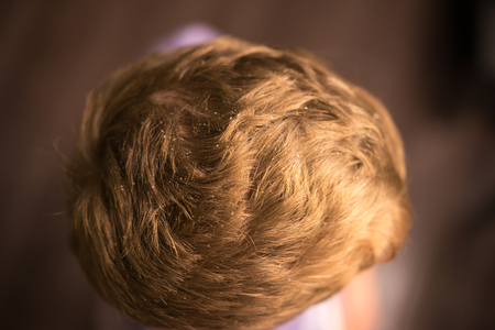 Dander that causes itching scalp. Closeupの写真素材