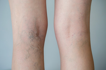 Varicose veins on a legの写真素材
