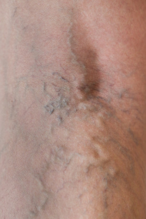 Varicose veins on a leg, close-upの写真素材