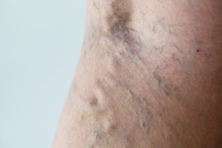 Varicose veins on a leg, close-upの写真素材