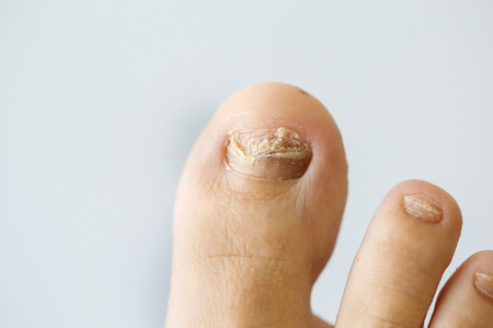Nail fungus on a toenailの写真素材