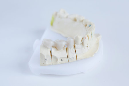 Dental plaster mold with ceramic crowns