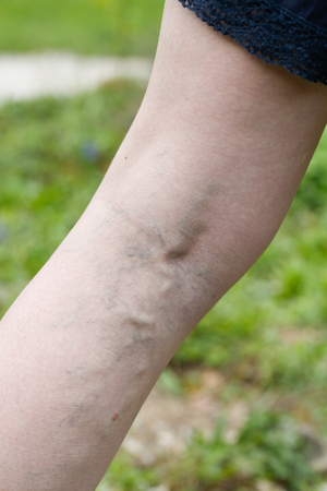 Woman with painful varicose and spider veins on her legs. Vascular disease, varicose veins problems, painful unaesthetic medical condition concept.の写真素材