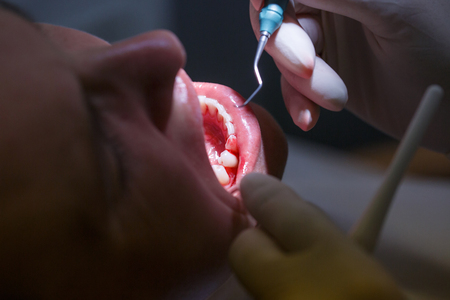 Patient at dental hygienists office, getting teeth cleaned of tartar and plaque, bleeding, preventing periodontal disease. Dental hygiene, painful procedures and prevention concept.の写真素材
