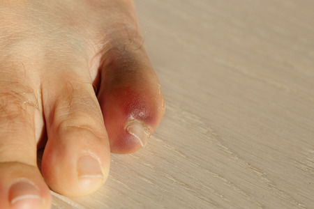 Little toe with severe inflammation and bruising. Injury, arthritis, rheumatism, disease concept. 
の写真素材