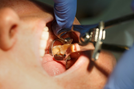 Patient getting dental treatment at dentist office with smart matrix system clamp, isolating the tooth, preparing it for composite restoration. Dental care, tools and technology concept.  
の写真素材
