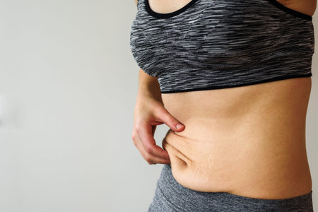 Woman belly after dieting. Skinny fat concept. Stretch marks