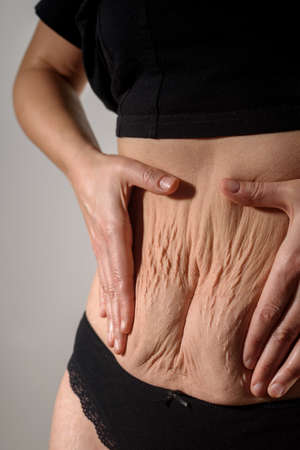 Woman squeeze her natural belly with stretch marks and scars. Body positiveの写真素材