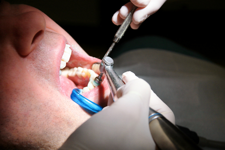 Dental tooth polishing. Teeth cleaning, dental hygiene. Dentist at work in his dentist clinic and office is polishing of patient teeth with tools mirror, soft dental brush and suction tube in mouth.の写真素材