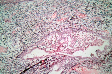 Microscope photo of tissue cells from a human cervix (neck of uterus) with cervical cancer cells.の写真素材