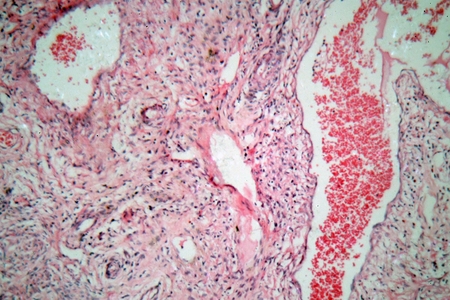Microscope photo of tissue cells from a human cervix (neck of uterus) with cervical cancer cells.