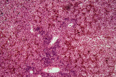 Human liver cells with cancer under the microscope.の写真素材