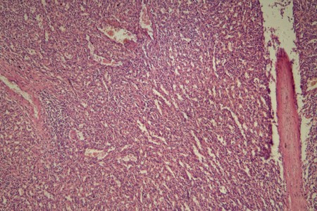 Cells of a human spleen with chronic myelogenous leukemia, under the microscope.
