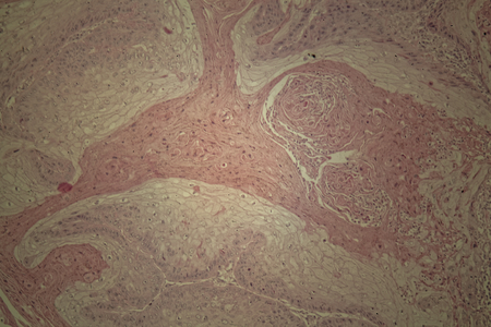 Cells of human skin with squamous cell carcinoma under a microscope.の写真素材