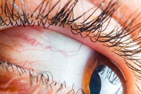 Medicine healthcare blood capillary human eye conjunctivitis closeup.の写真素材