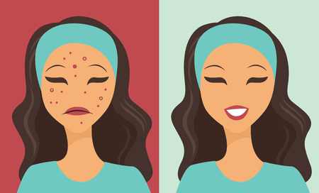 Unhappy teen girl struggling with acne flat vectorのイラスト素材