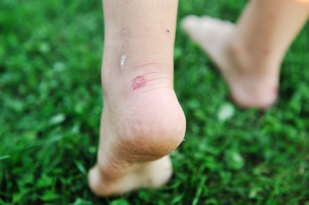 Walking on grass with callus on feet