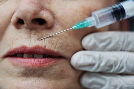 Needle injection on mature woman faceの写真素材