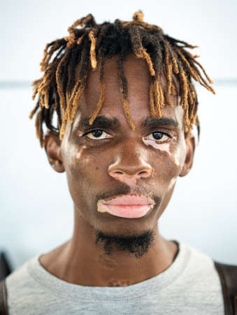 African American black young man with vitiligo skinの写真素材