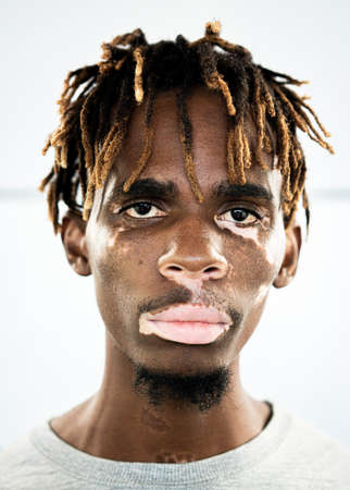 African American black young man with vitiligo skinの写真素材