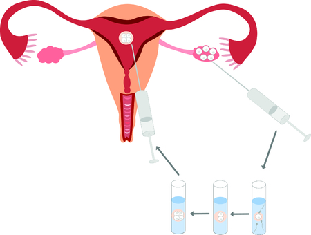 In vitro fertilizationのイラスト素材